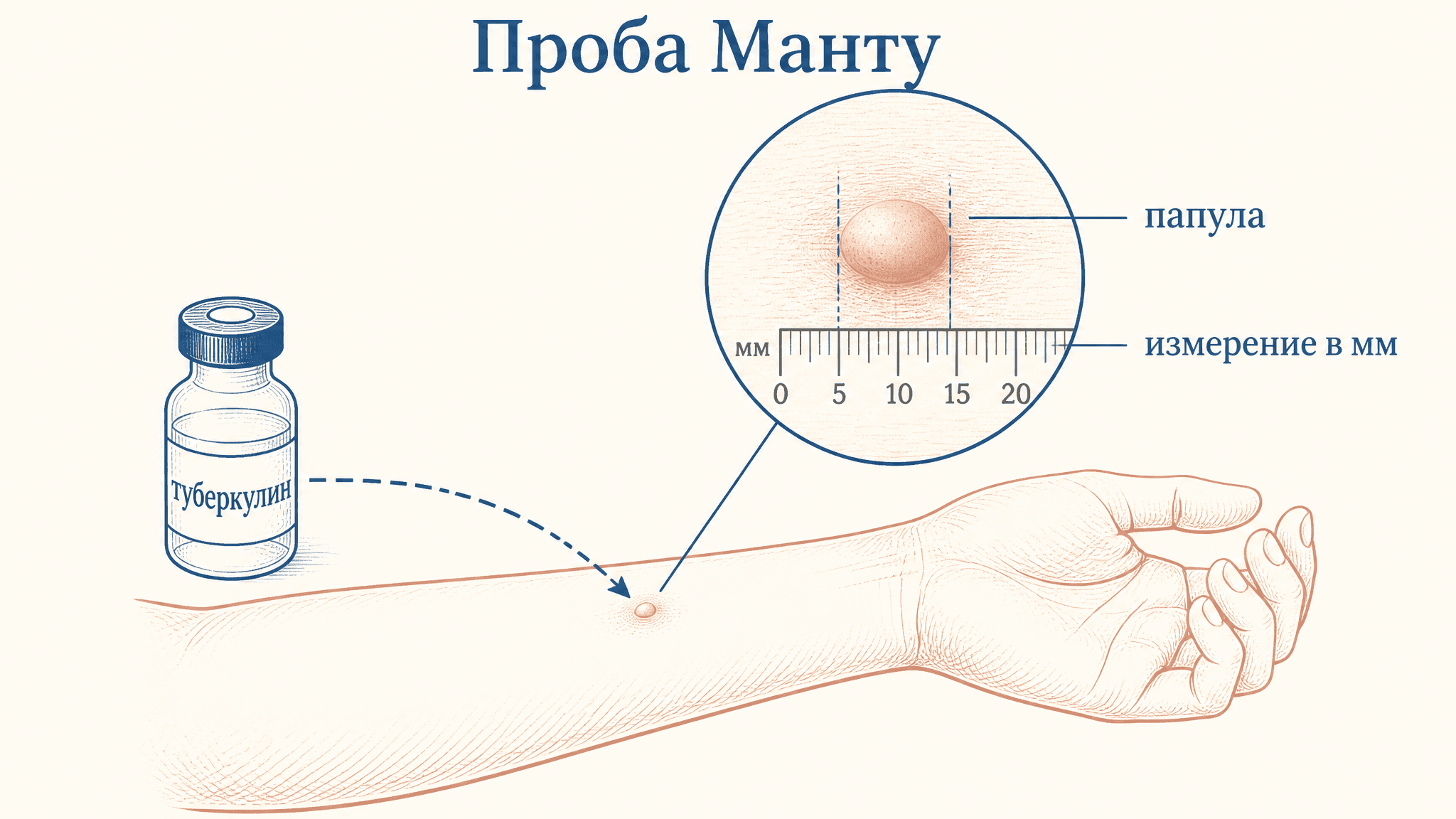 Реакция Манту: туберкулиновая проба и оценка результата