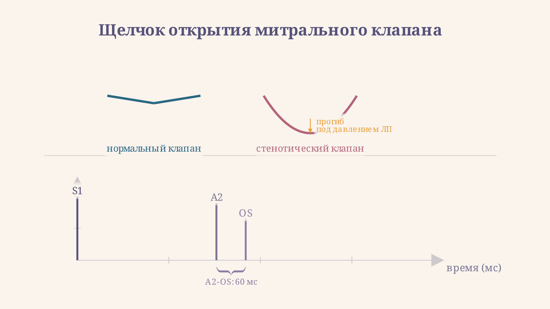 Щелчок открытия митрального клапана: A2-OS и стеноз