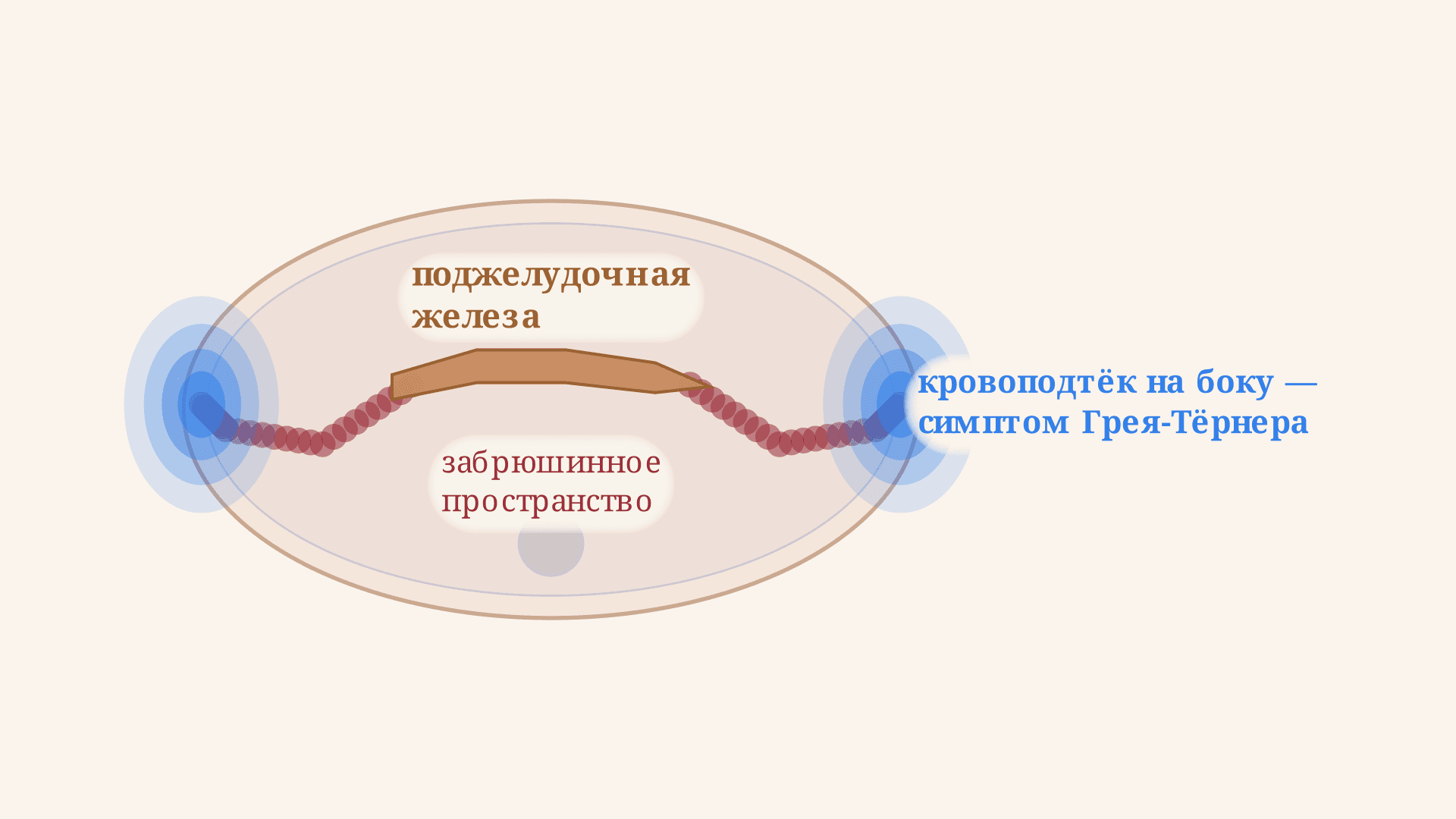Симптом Грея-Тёрнера: о чём говорит этот признак