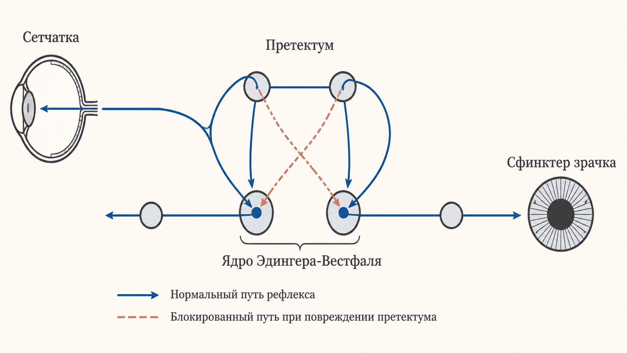 Синдром Аргайла-Робертсона: диссоциация зрачковых реакций