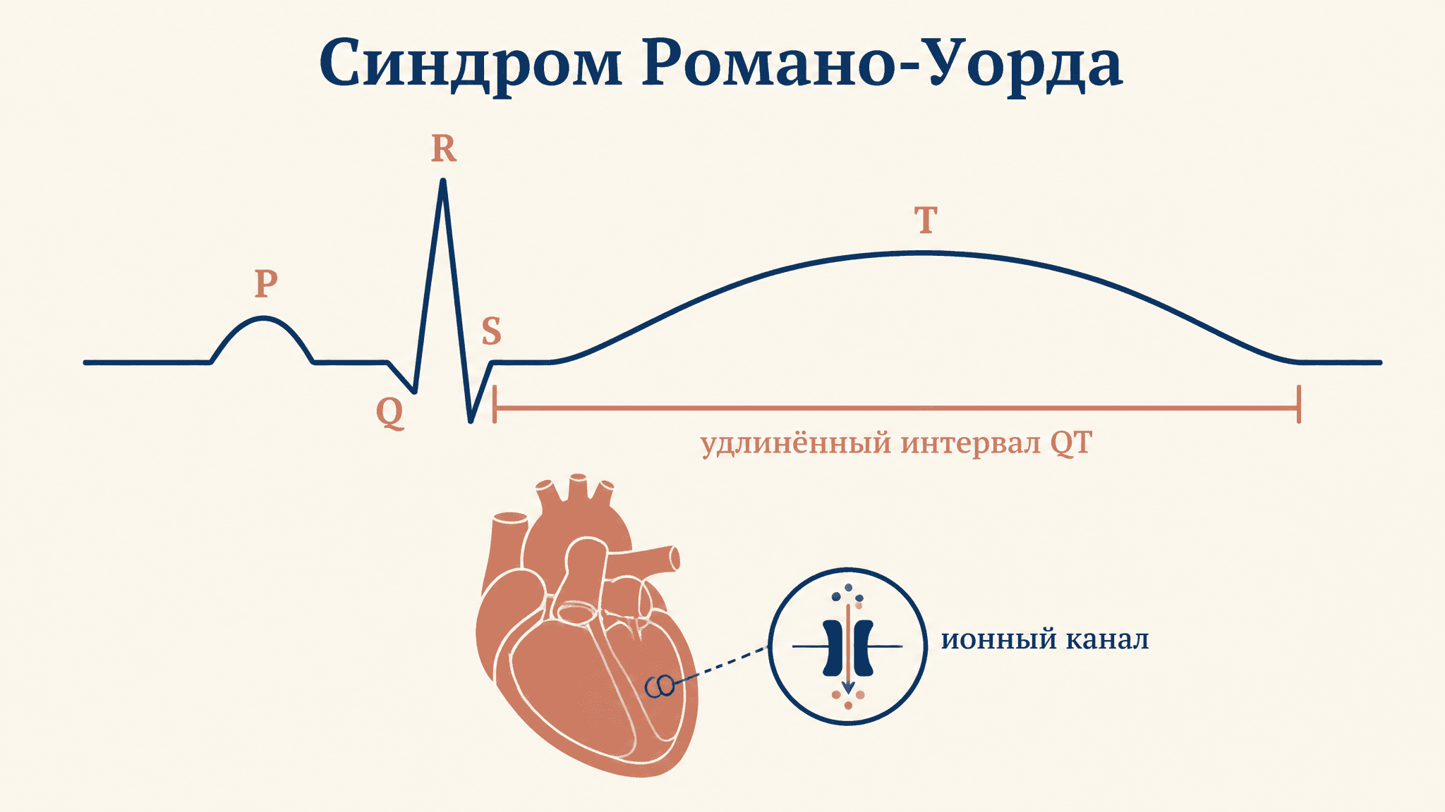 Синдром Романо-Уорда: причины, ЭКГ и наследование