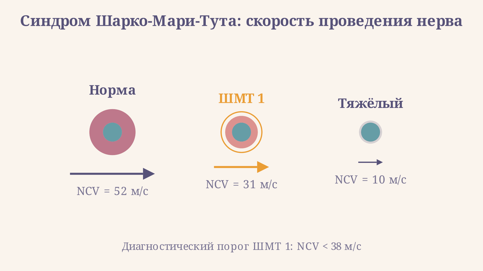 Синдром Шарко-Мари-Тута: ЭНМГ, гены и диагностика