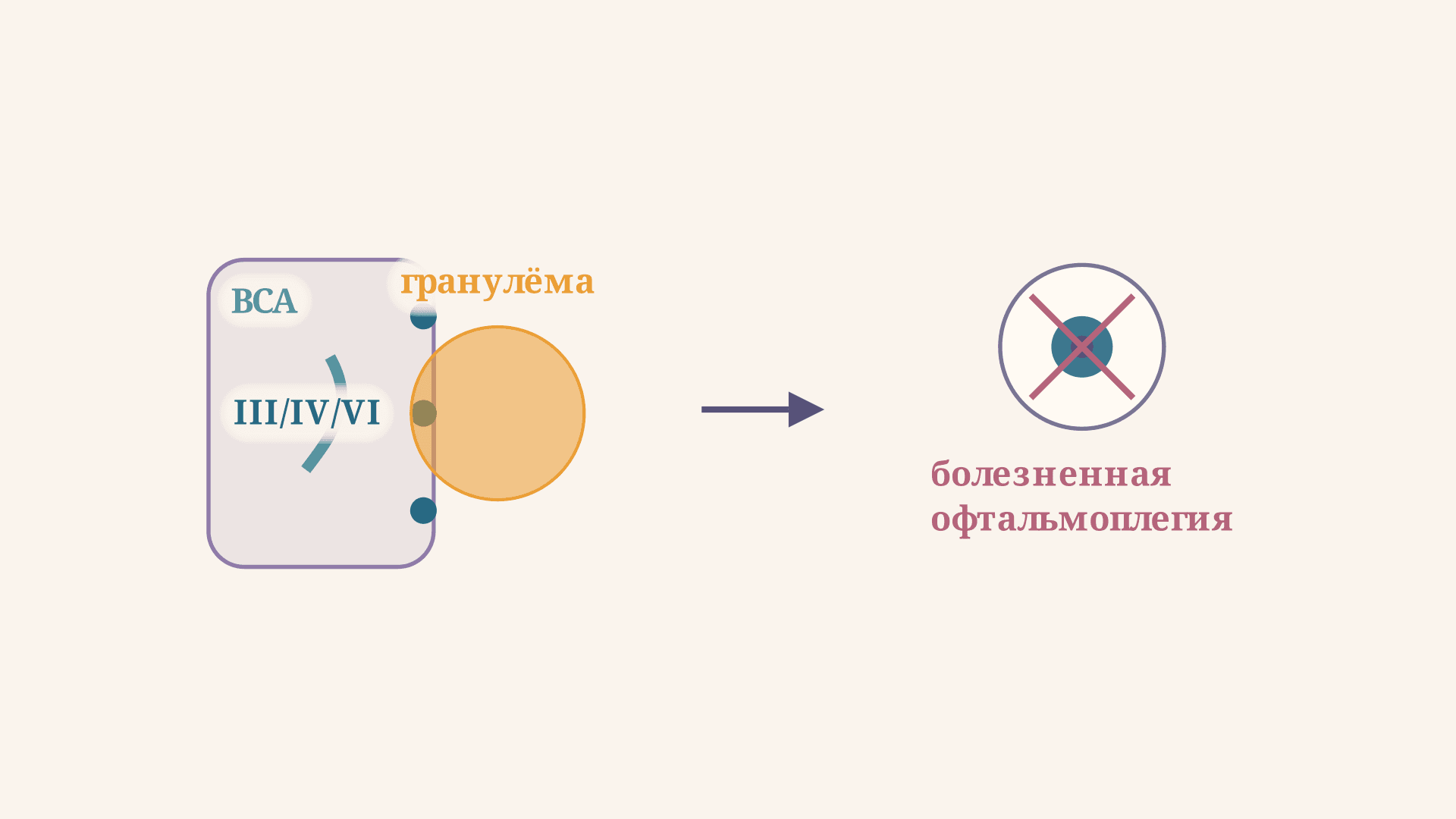 Синдром Толоса-Ханта: критерии, диагностика и лечение