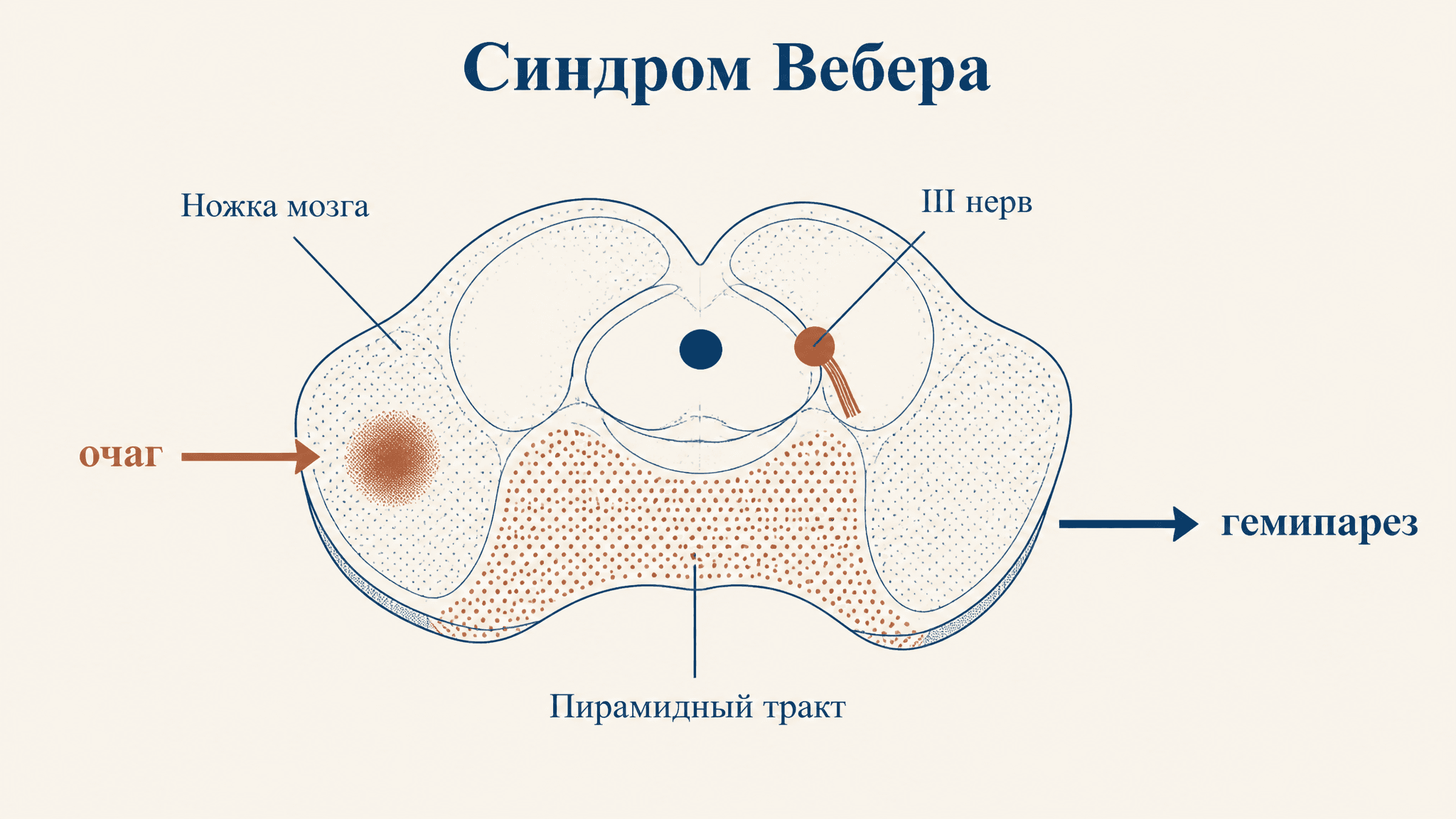 Синдром Вебера: поражение ножки мозга и его клиника