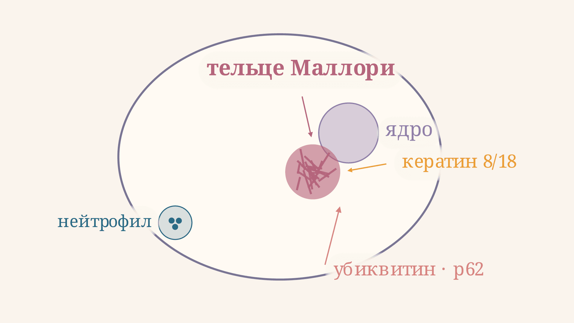 Телца Маллори: что это, гистология и алкогольный гепатит
