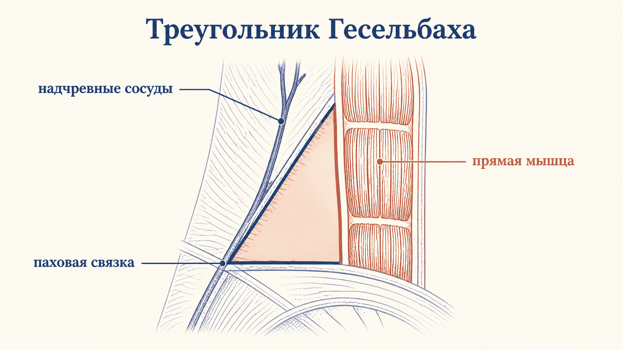 Треугольник Гесельбаха: границы и грыжи