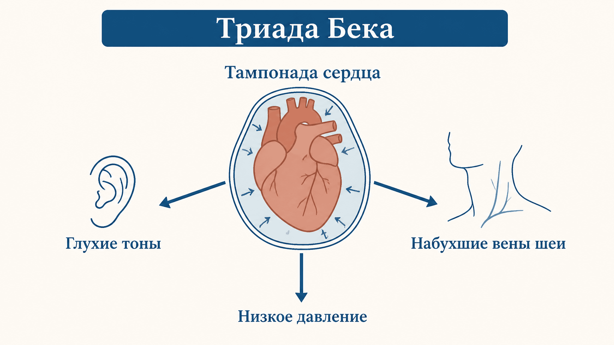Триада Бека: три признака тампонады сердца