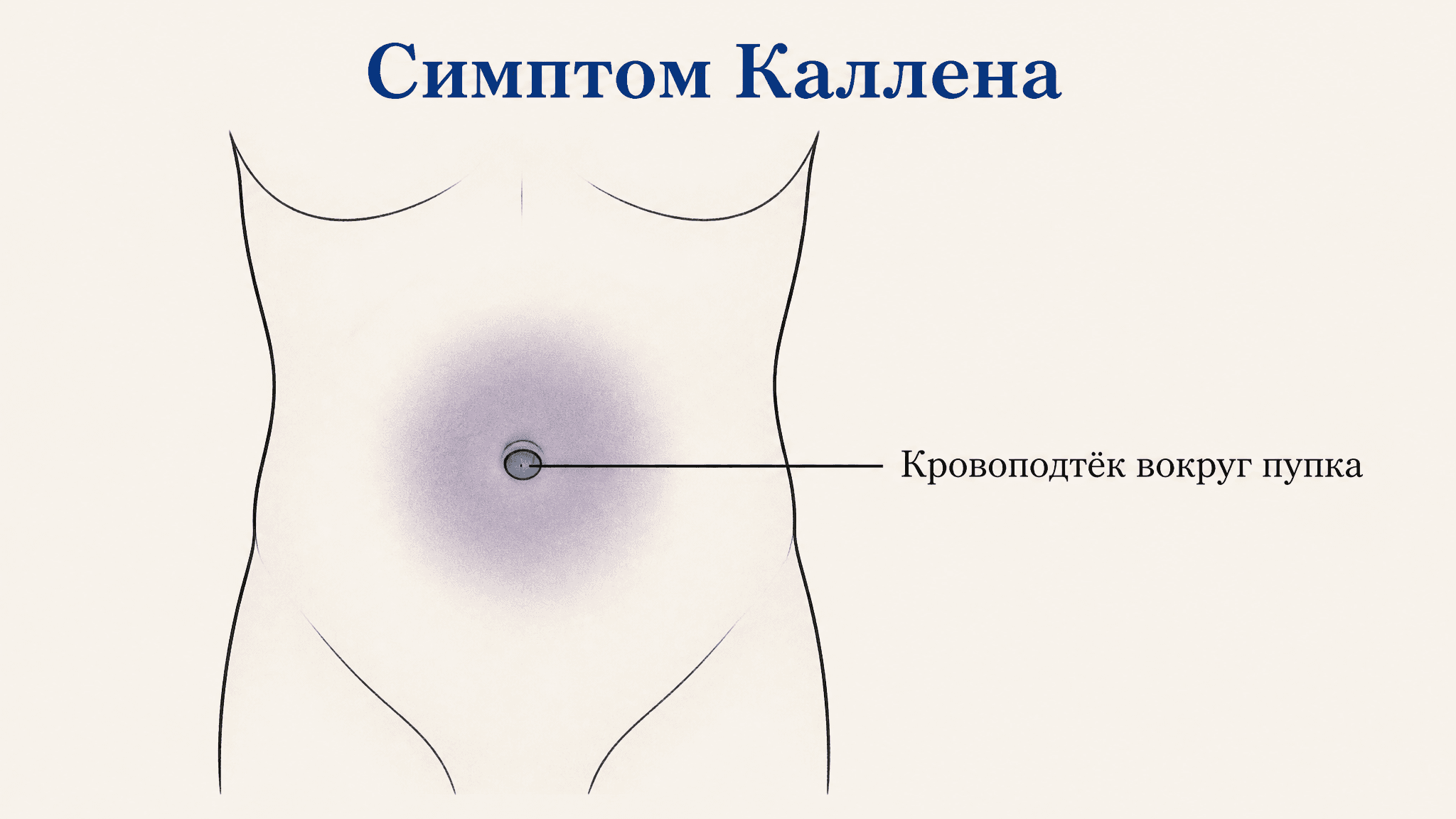 Симптом Каллена: что значит синяк вокруг пупка