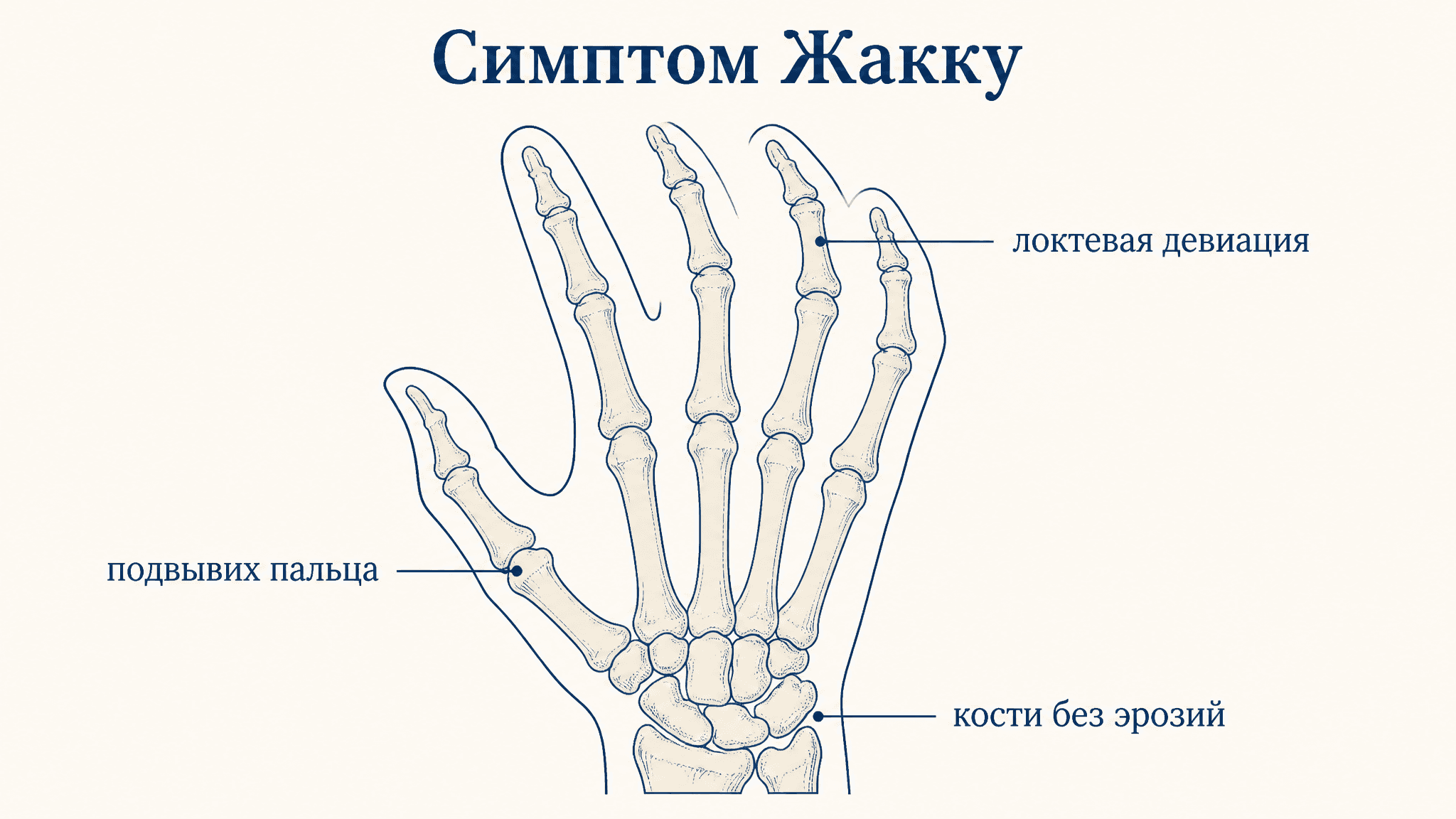 Симптом Жакку: артропатия без эрозий суставов