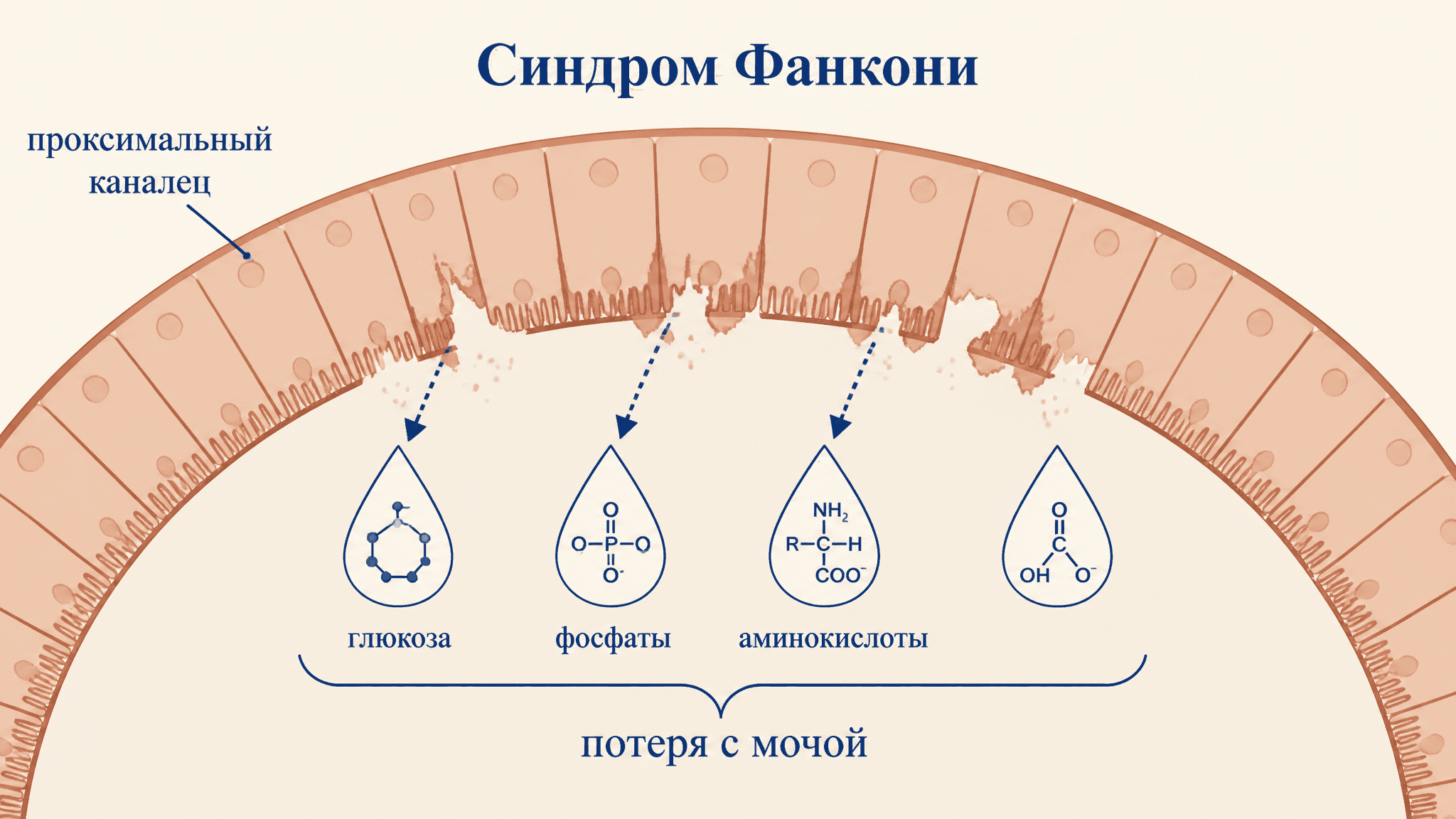 Синдром Фанкони: дисфункция проксимального канальца почки