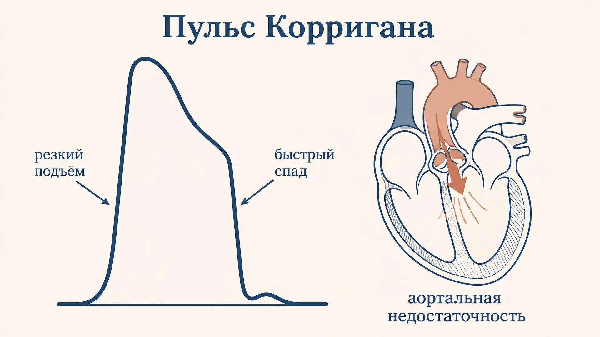 Пульс Корригана: что это, причины и как выявить