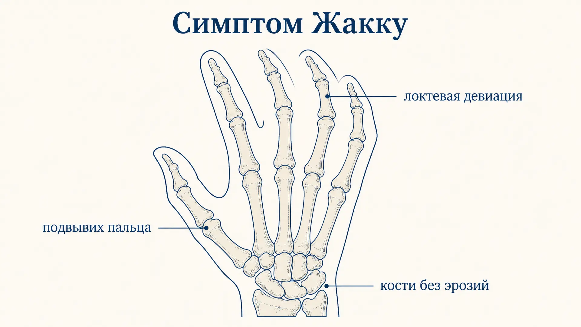 Симптом Жакку: артропатия без эрозий суставов