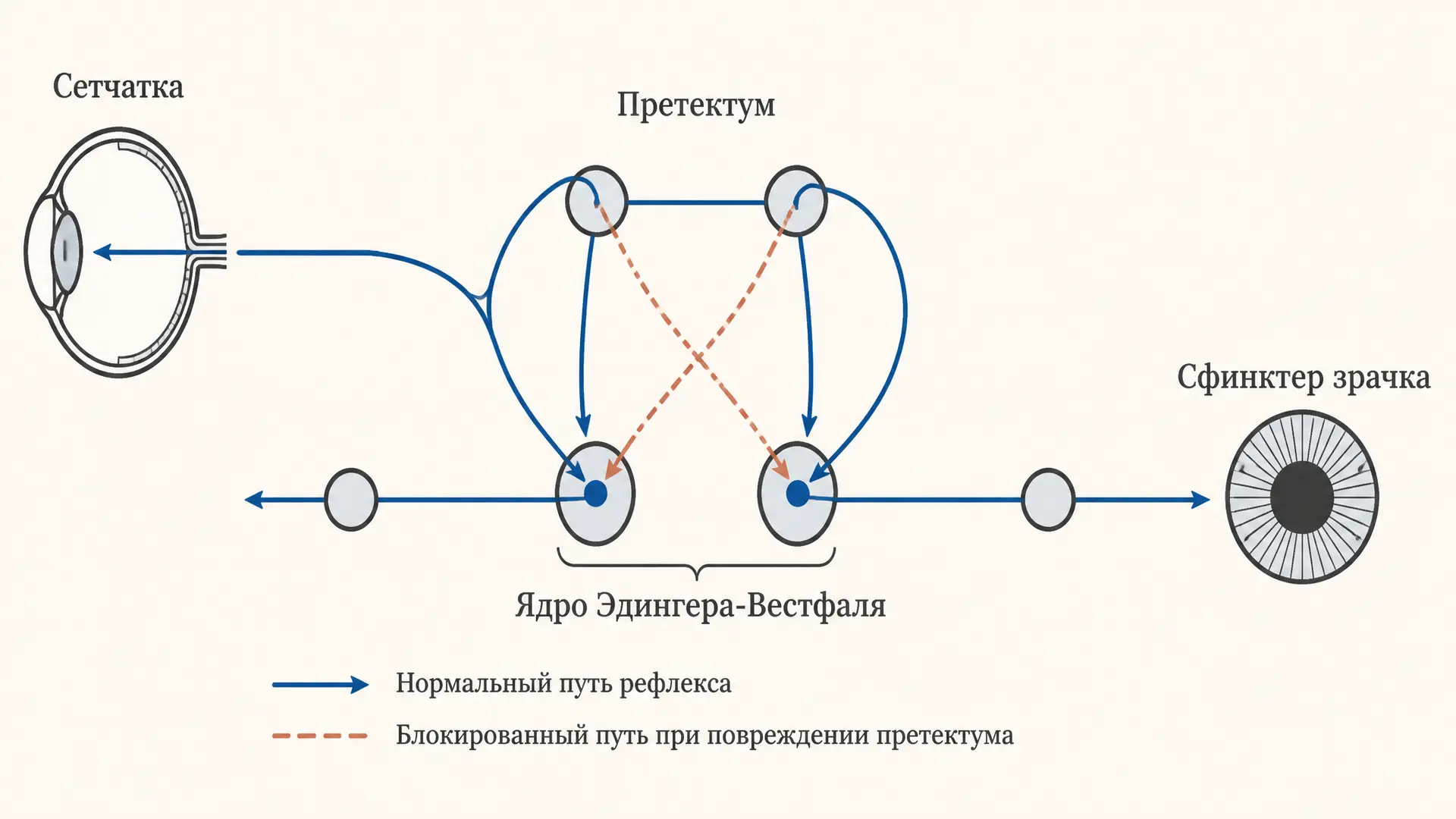 Синдром Аргайла-Робертсона: диссоциация зрачковых реакций