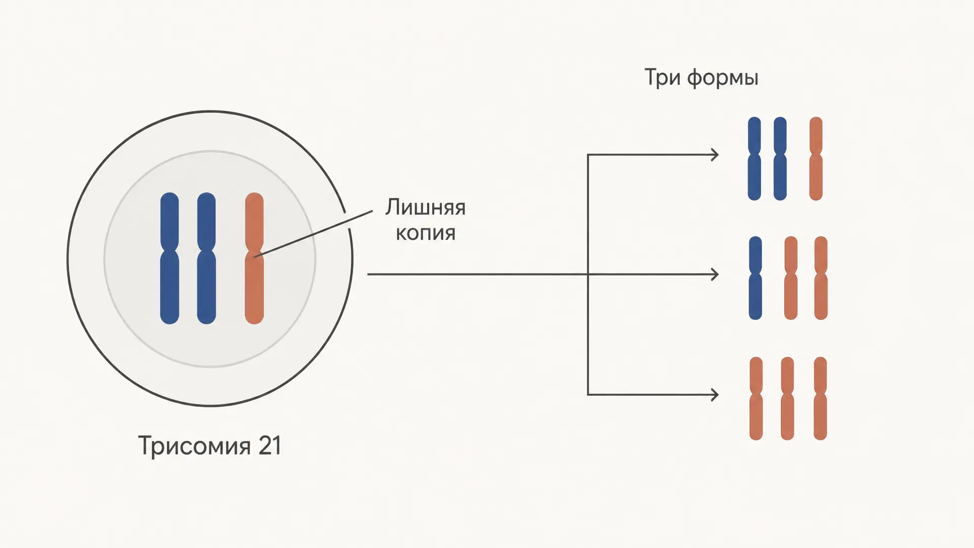 Синдром Дауна: трисомия 21 и её формы