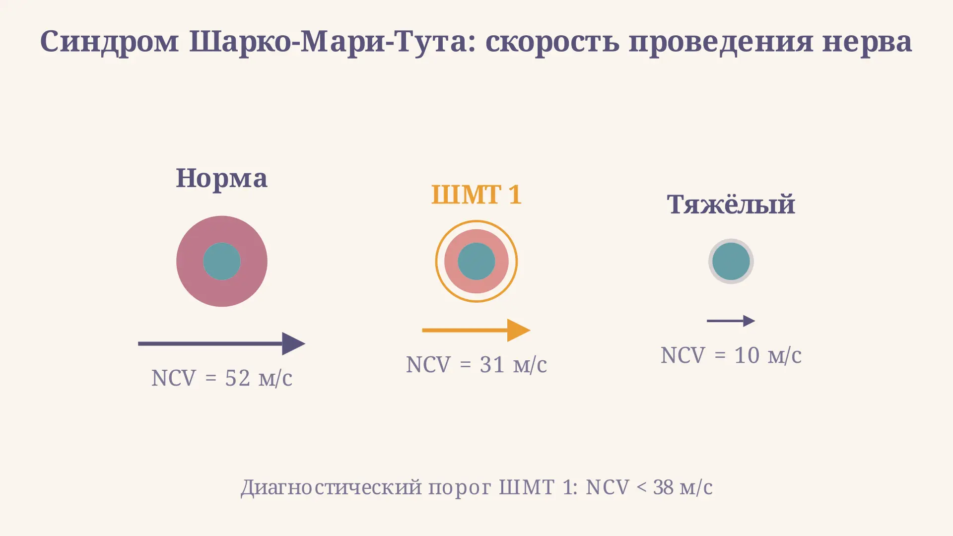 Синдром Шарко-Мари-Тута: ЭНМГ, гены и диагностика