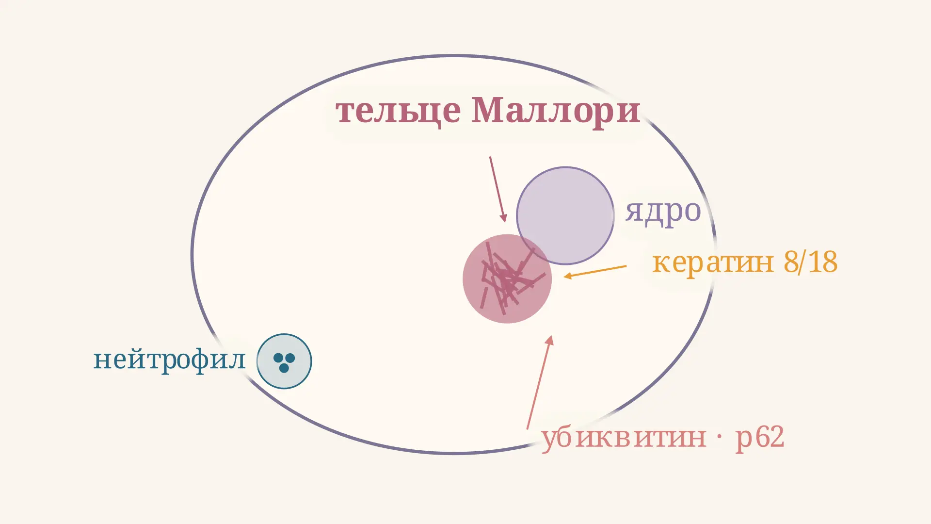 Телца Маллори: что это, гистология и алкогольный гепатит