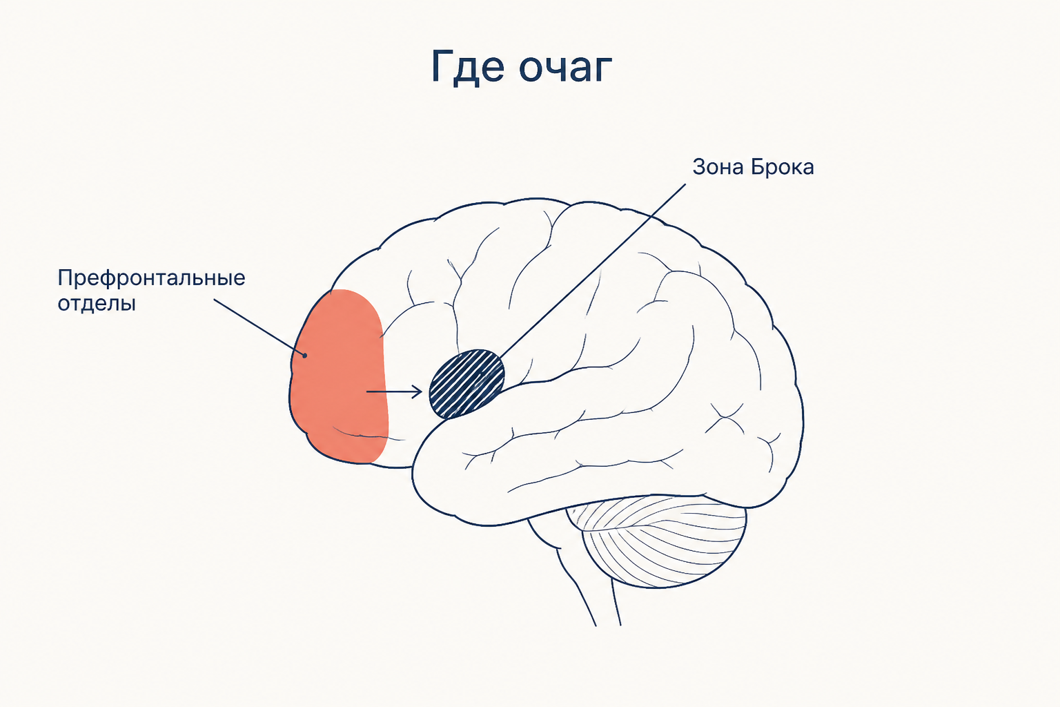 Схема очага: коралловым закрашены префронтальные отделы левого полушария, кпереди от заштрихованной зоны Брока