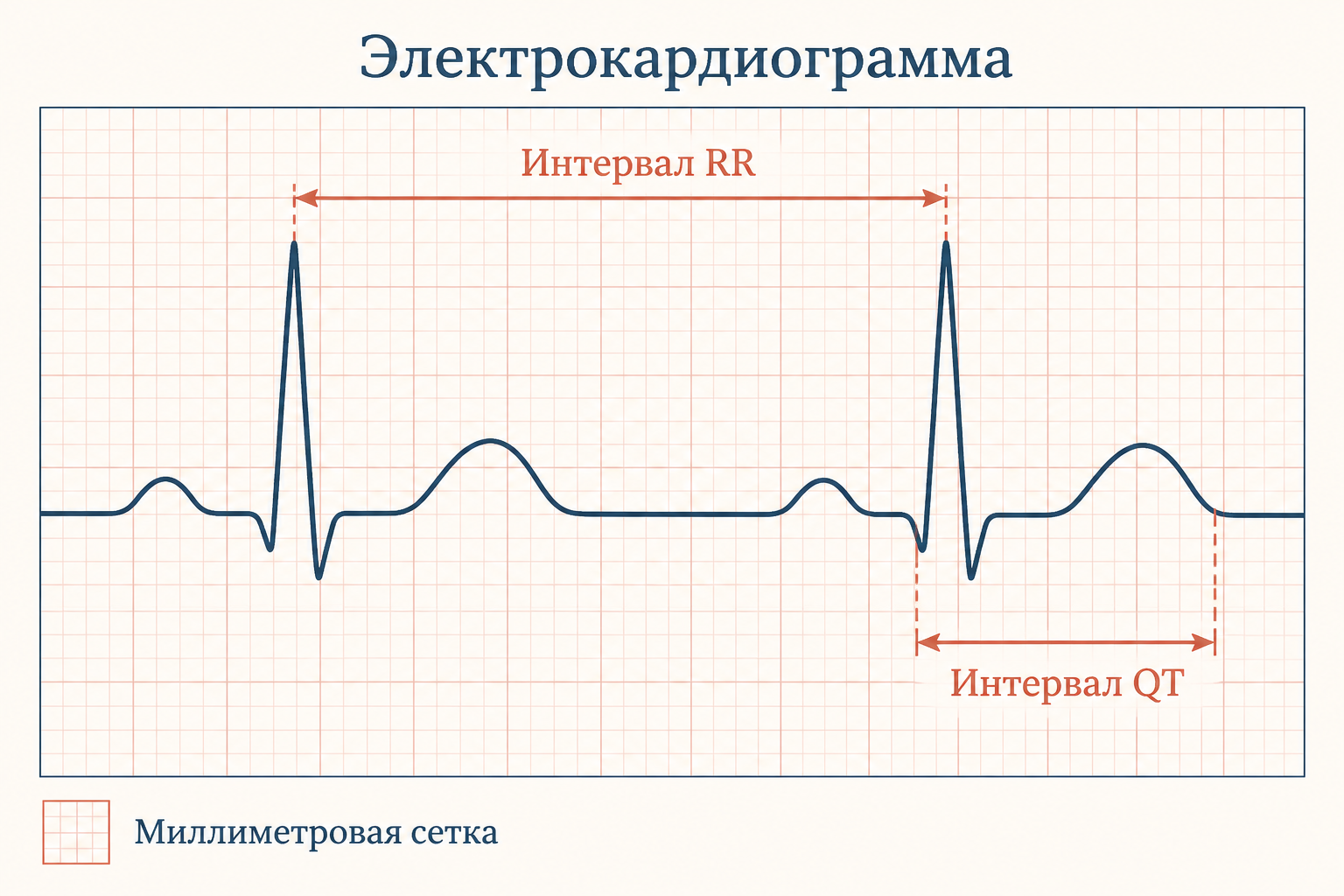Измерение интервалов RR и QT по миллиметровой сетке
