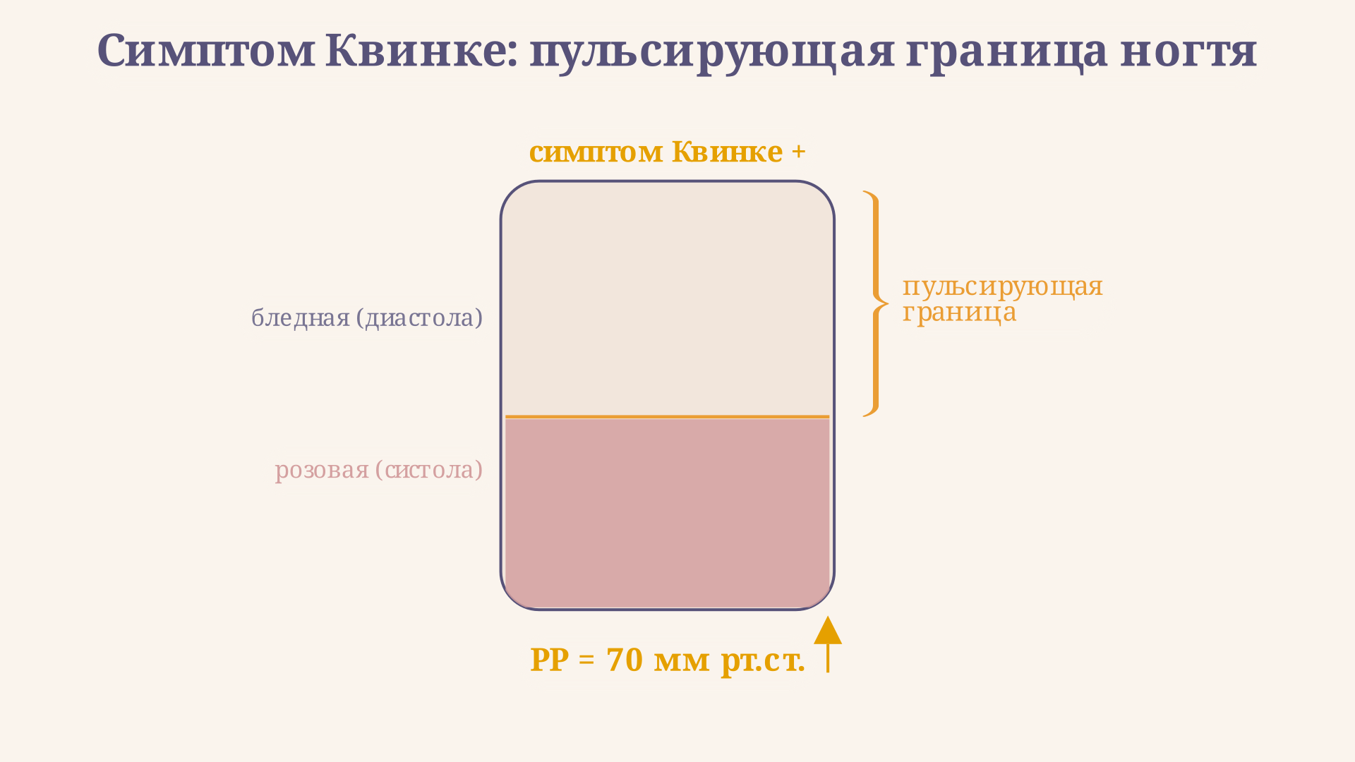 Схема выявления симптома Квинке у ногтевого ложа: надавливание создаёт бледное пятно, граница которого пульсирует при PP более 60 мм рт. ст.