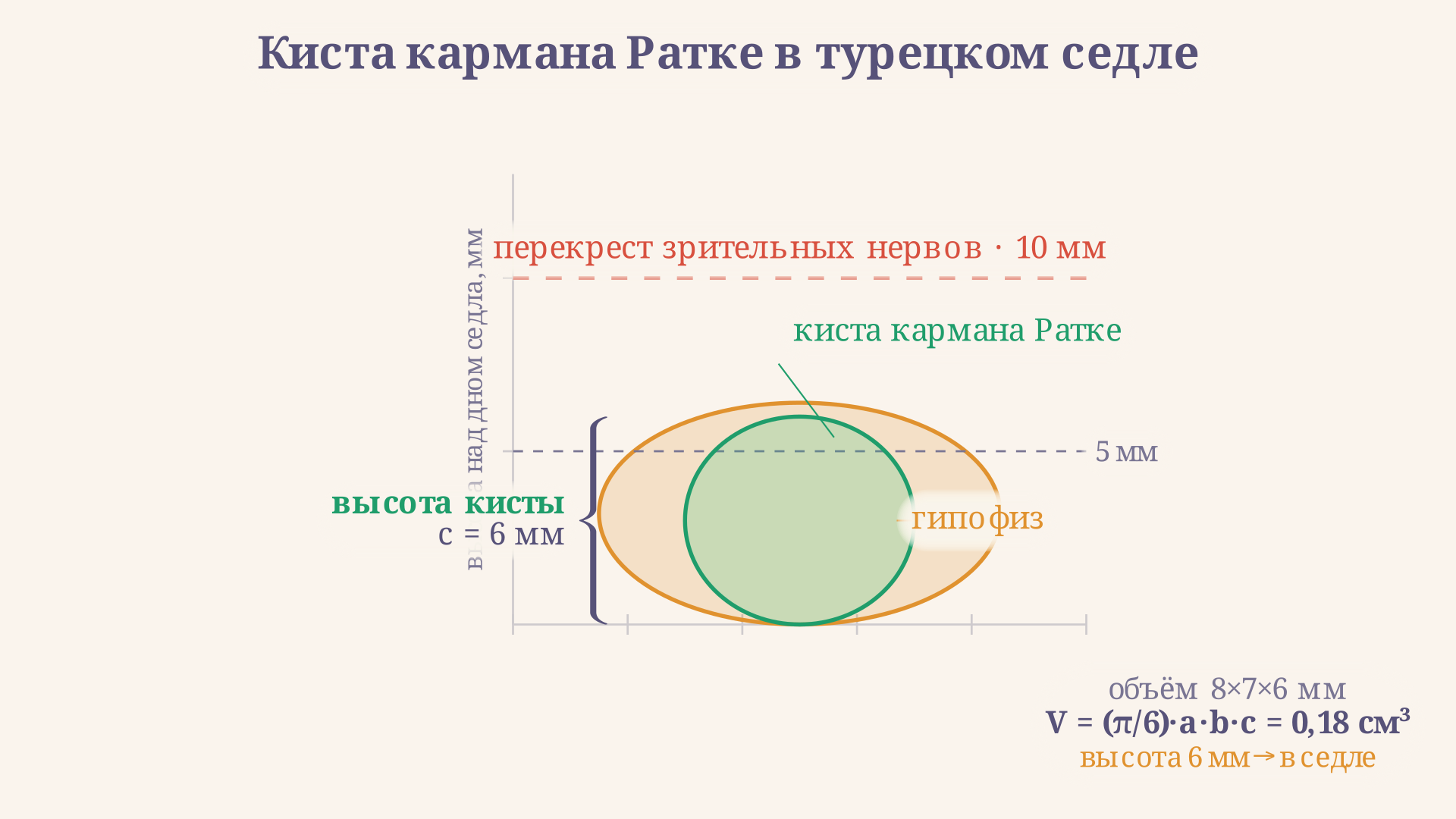 Сагиттальный разрез: киста кармана Ратке в турецком седле, ее вертикальный размер измеряется до линии перекреста зрительных нервов