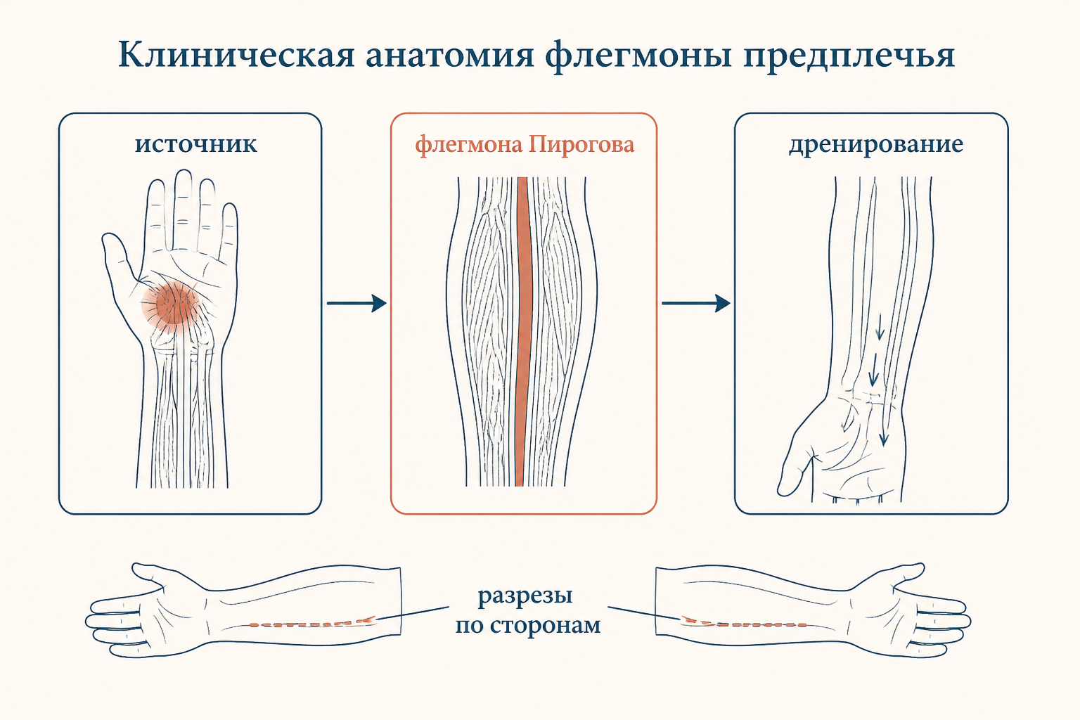 Клиническая схема флегмоны предплечья: источник на кисти, заполнение пространства Пирогова и дренирование разрезами по сторонам