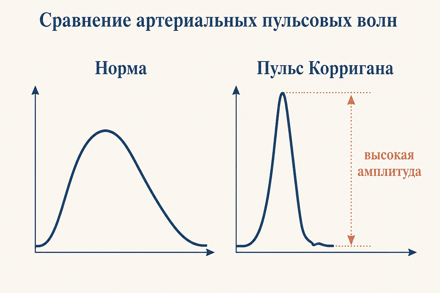 Сравнение нормальной пульсовой волны с округлой вершиной и волны Корригана с резким высоким подъёмом и быстрым спадом