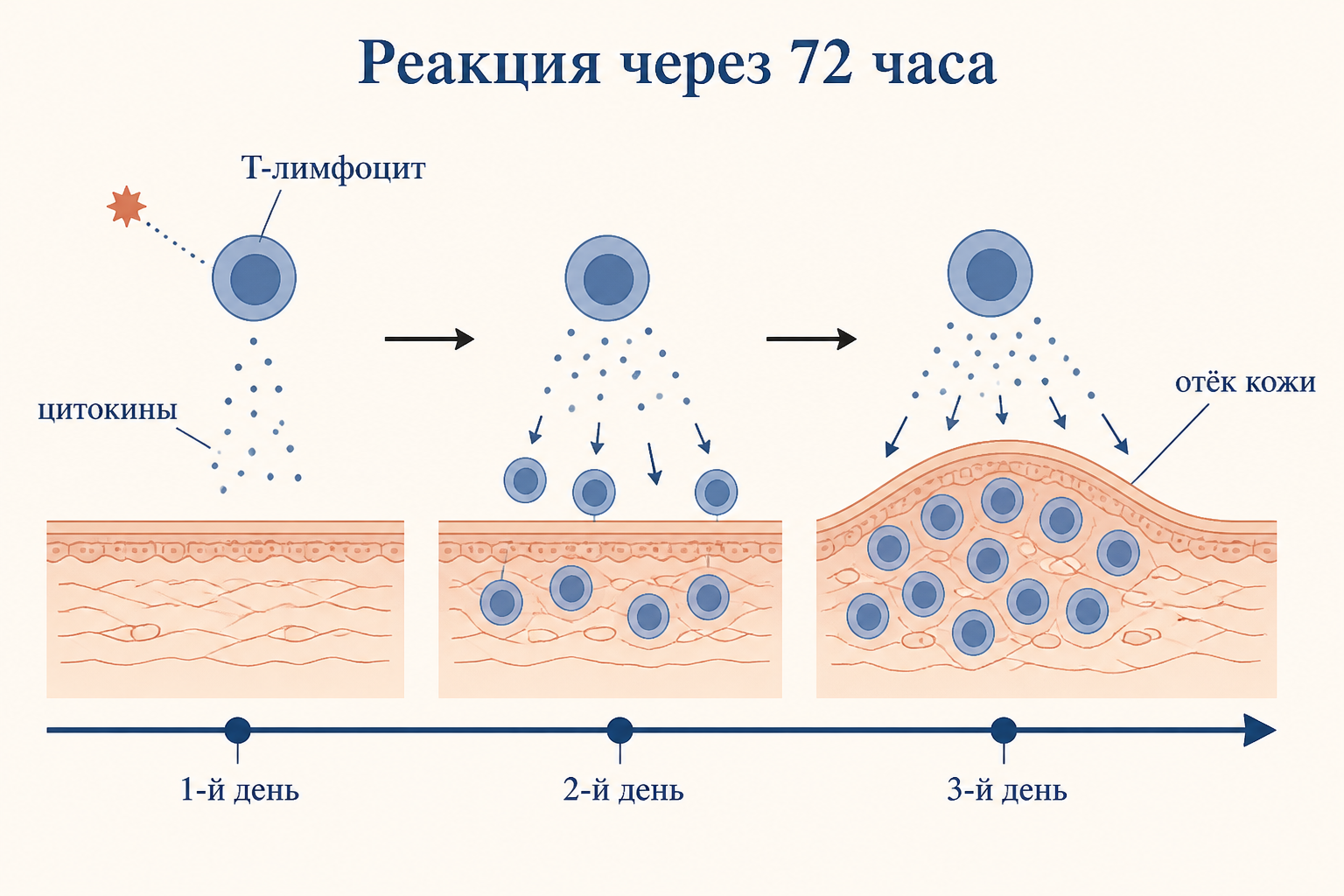 Проба Манту: вводят туберкулин внутрикожно, через 72 часа измеряют папулу линейкой в миллиметрах
