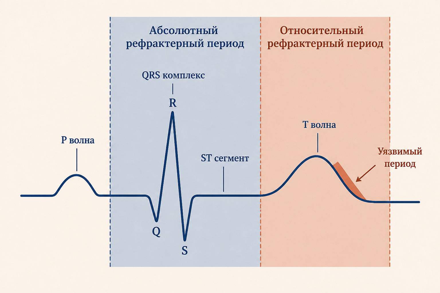 Рефрактерный период на ЭКГ: абсолютный соответствует зубцу Q, сегменту ST и началу T, относительный - нисходящей части T - уязвимому периоду