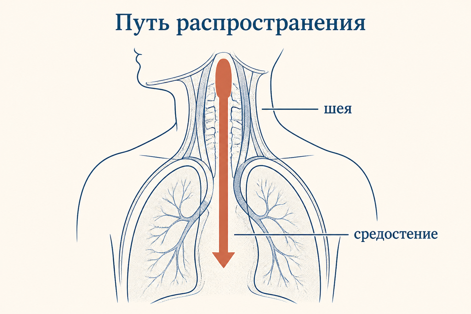 Путь распространения инфекции из заглоточного пространства вниз в средостение грудной клетки