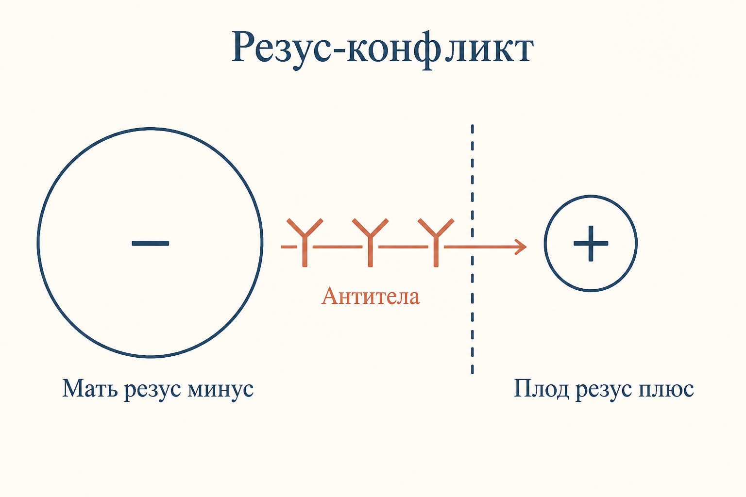 Схема резус конфликта: мать резус минус, плод резус плюс, материнские антитела проходят через плаценту