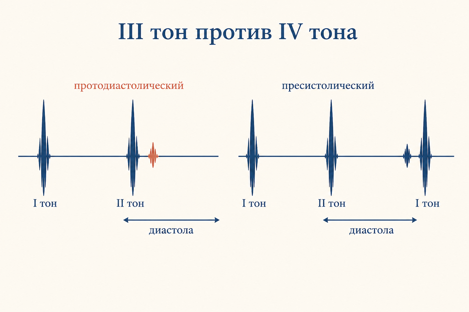 Положение III тона на фонокардиограмме: между II тоном и следующим I тоном, в ранней диастоле, отмечен короткий добавочный спайк галопа