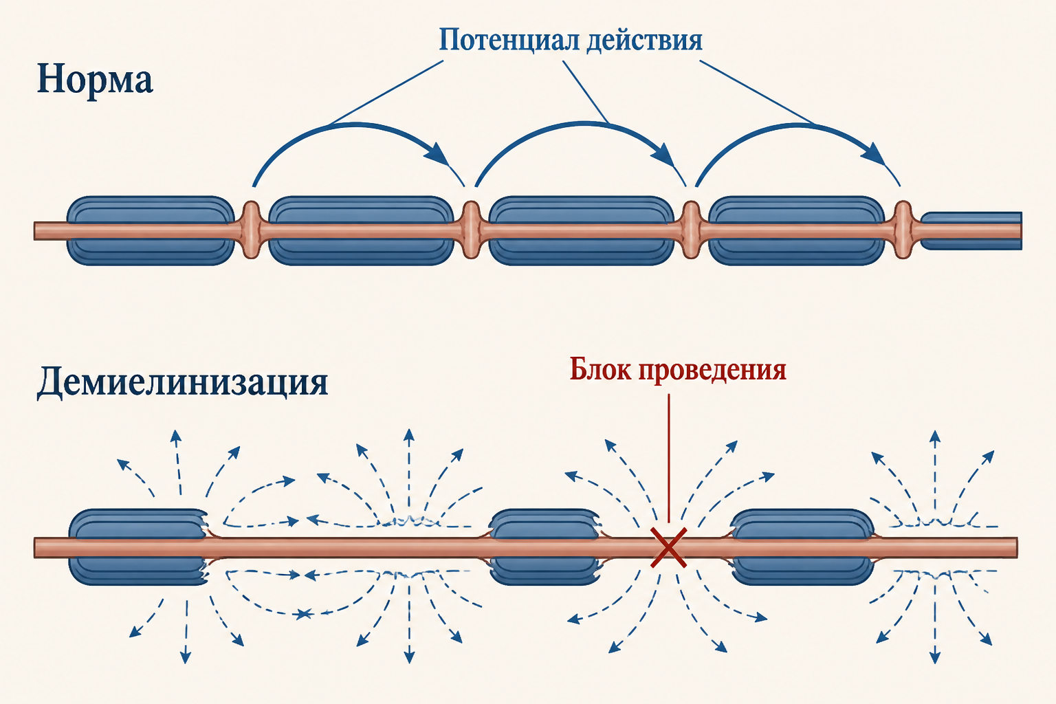 Сравнение нормального и демиелинизированного волокна: место потенциала действия, рассеяние тока