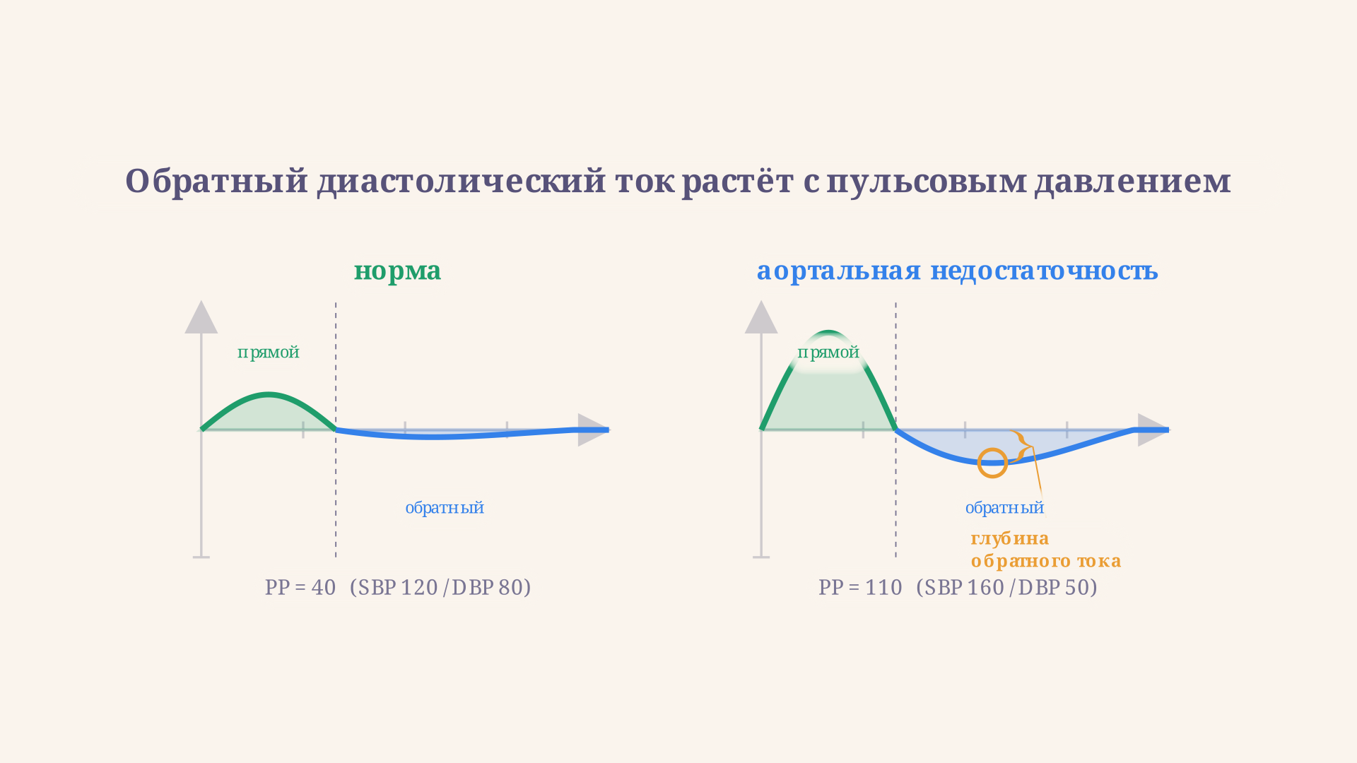 Сравнение кровотока в бедренной артерии в норме и при аортальной недостаточности: в норме только систолический прямой ток, при пороке добавляется глубокий диастолический обратный ток