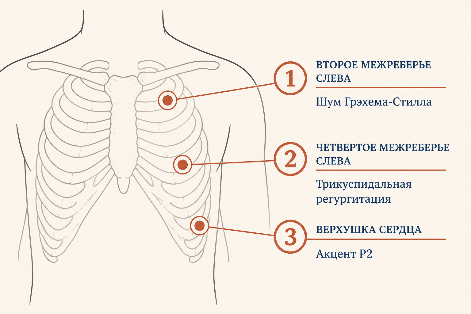 Типичная схема аускультации при лёгочной гипертензии: акцент P2, шум трикуспидальной регургитации и шум Грэхема-Стилла