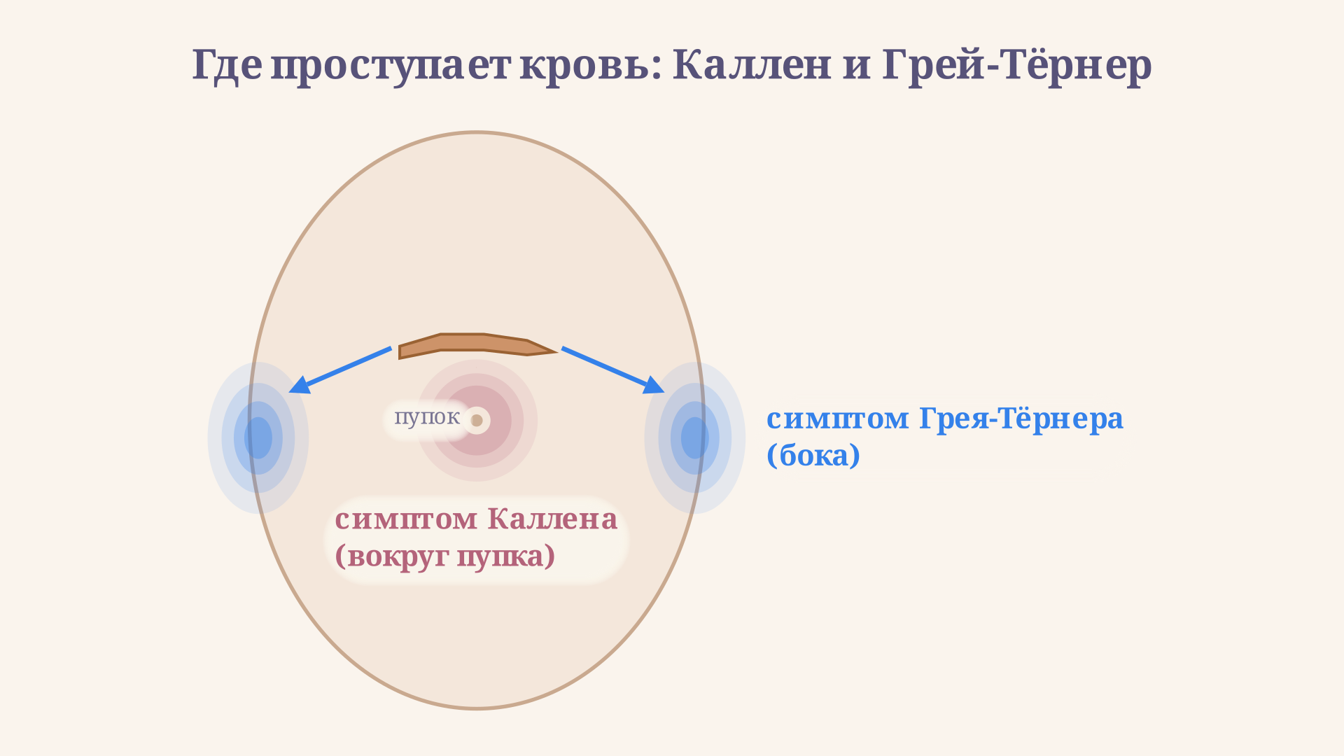 Схема живота: симптом Каллена показан кровоподтёком вокруг пупка, симптом Грея-Тёрнера - на боковых поверхностях; стрелками отмечены пути распространения крови