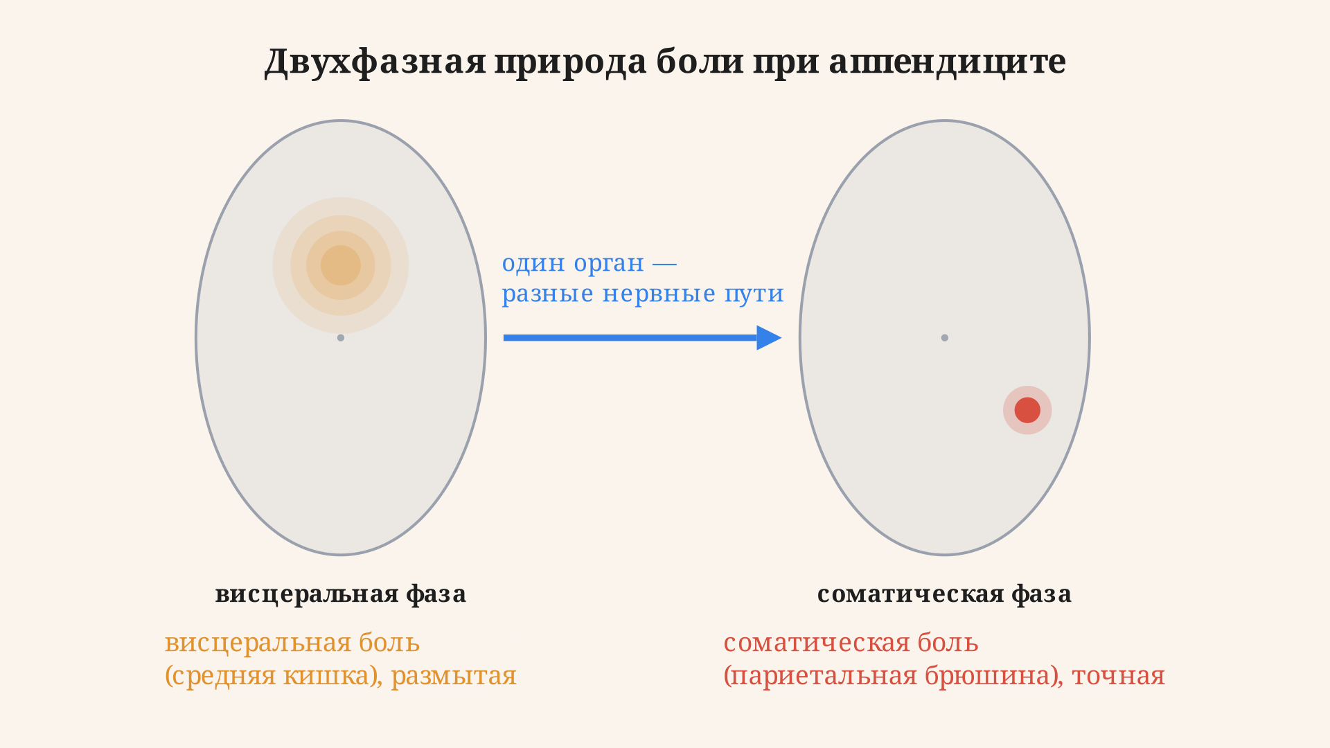 Двухфазная природа боли при аппендиците: висцеральная фаза дает размытую боль в эпигастрии, соматическая фаза локализует ее в правой подвздошной области