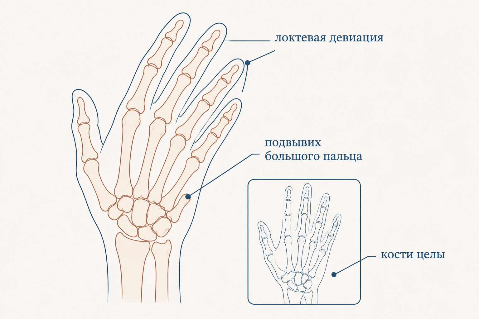 Кисть с деформациями Жакку: локтевая девиация пальцев и подвывих большого пальца, кости без эрозий
