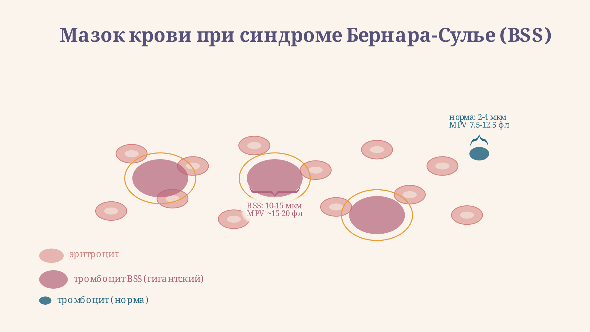 Мазок крови при синдроме Бернара-Сулье: гигантские тромбоциты соразмерны эритроцитам, их число снижено