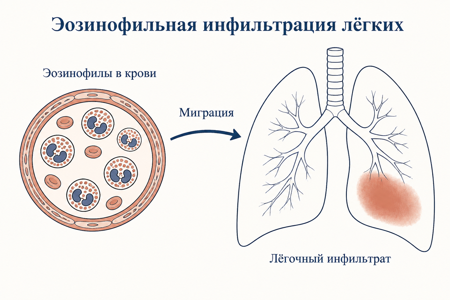 Схема лёгочной эозинофилии: мигрирующий инфильтрат и эозинофилы в крови