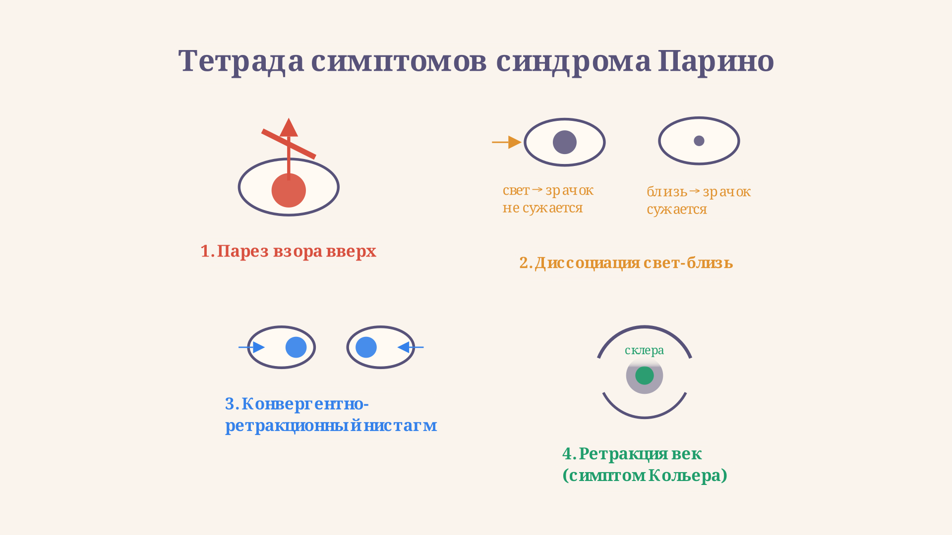 Тетрада синдрома Парино: парез взора вверх, диссоциация свет-близь, конвергентно-ретракционный нистагм и симптом Кольера показаны на схеме глаз с подписями