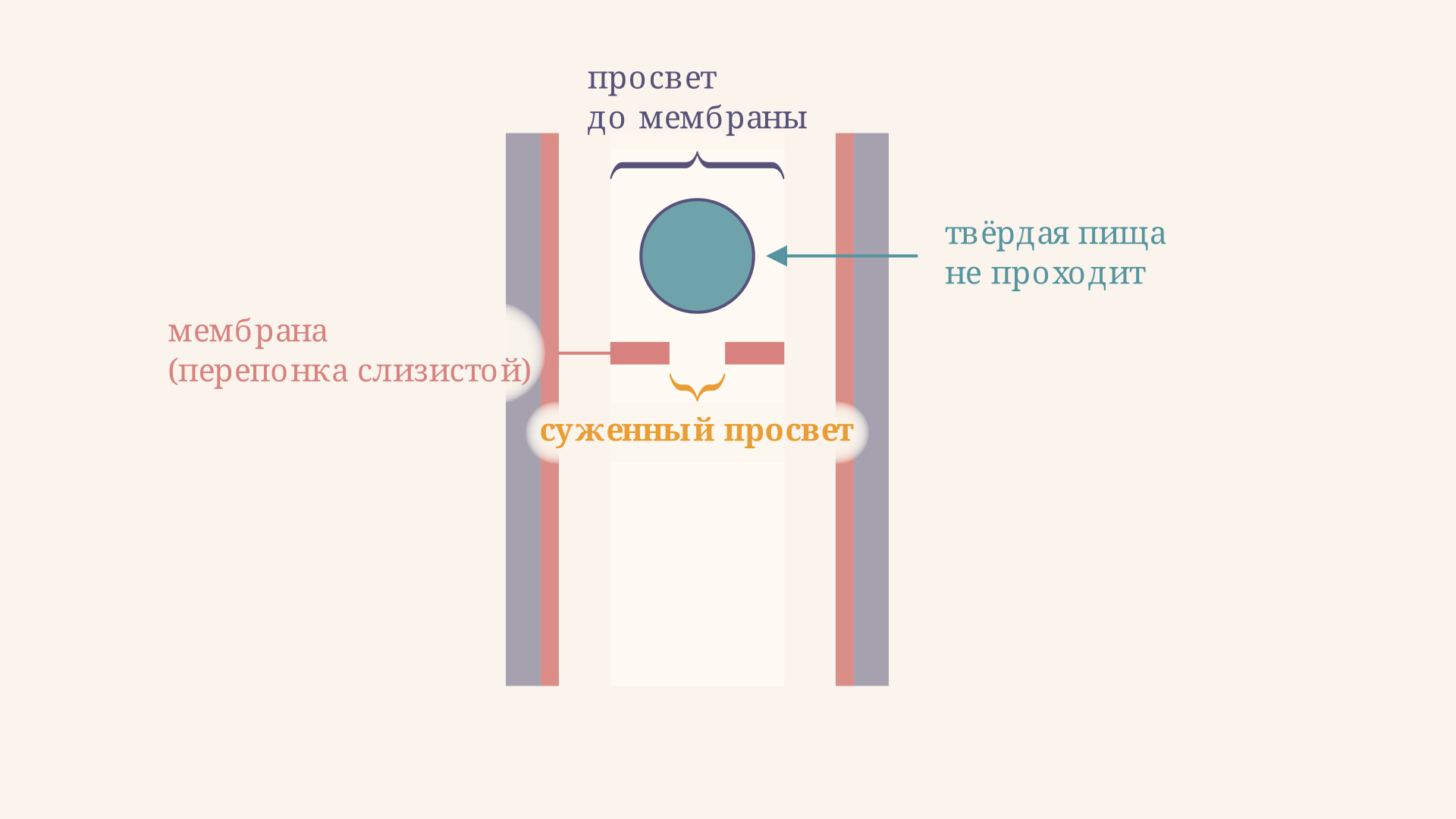 Схема пищевода с мембраной в шейном отделе: тонкая перепонка слизистой частично перекрывает просвет, и пищевой комок упирается в неё, вызывая дисфагию