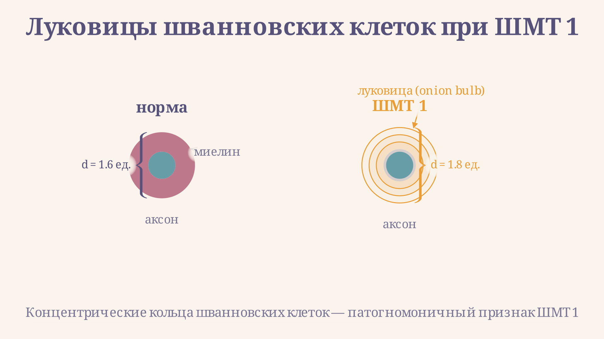Схема поперечного среза демиелинизированного нерва при ШМТ 1: видны «луковицы» из пролиферирующих шванновских клеток вокруг истончённого аксона