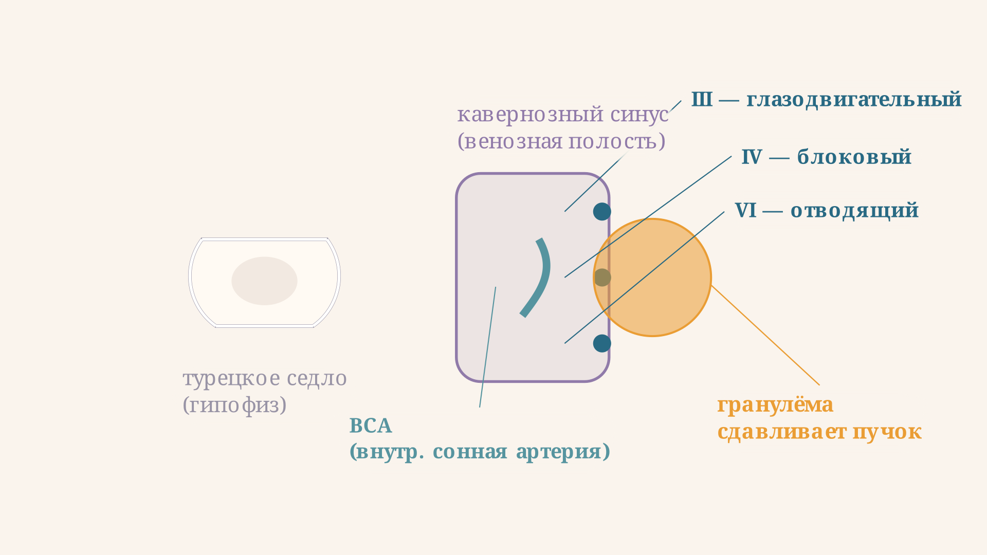 Схема кавернозного синуса в поперечном срезе: глазодвигательный, блоковый и отводящий нервы и внутренняя сонная артерия, гранулёма сдавливает нервы сбоку