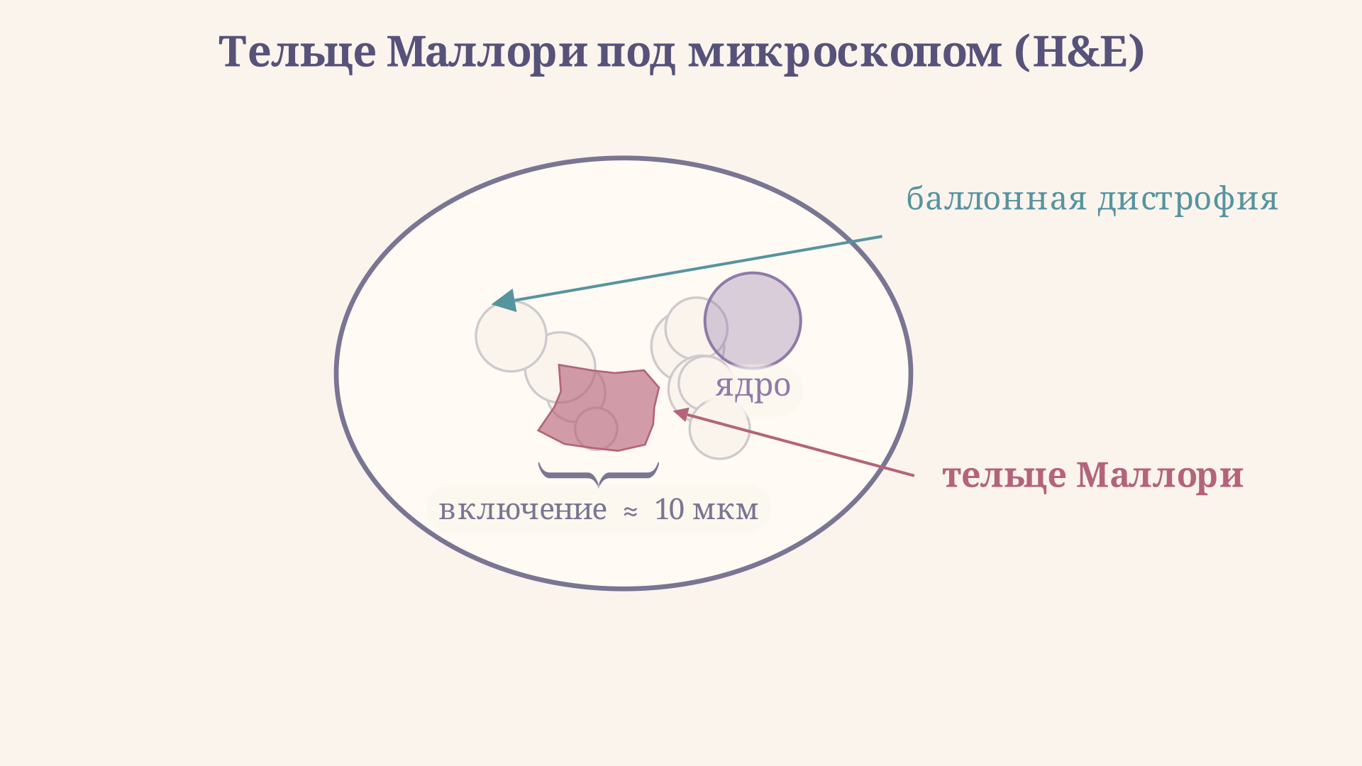Гепатоцит с тельцем Маллори: набухшая баллонная клетка со светлой цитоплазмой и плотным эозинофильным включением неправильной формы вокруг ядра