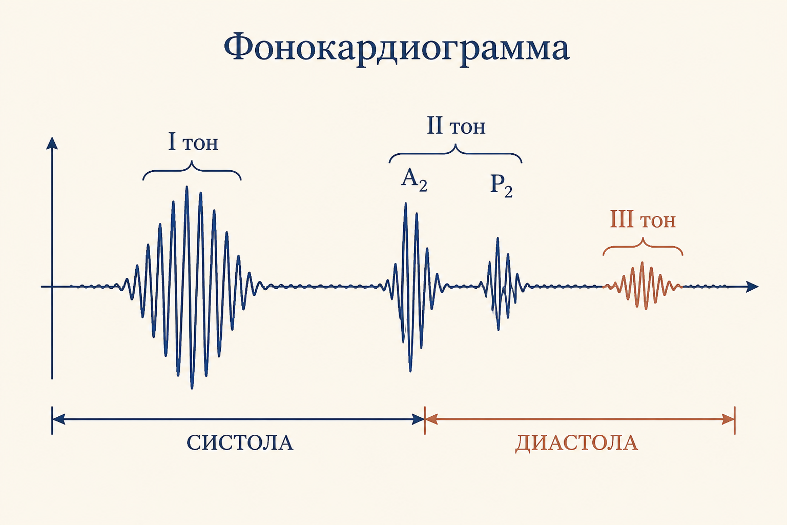 Фонокардиограмма: I тон, II тон с расщеплением, патологический III тон - схема записи
