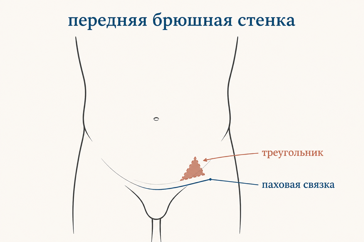 Схема расположения треугольника Гесельбаха на передней брюшной стенке