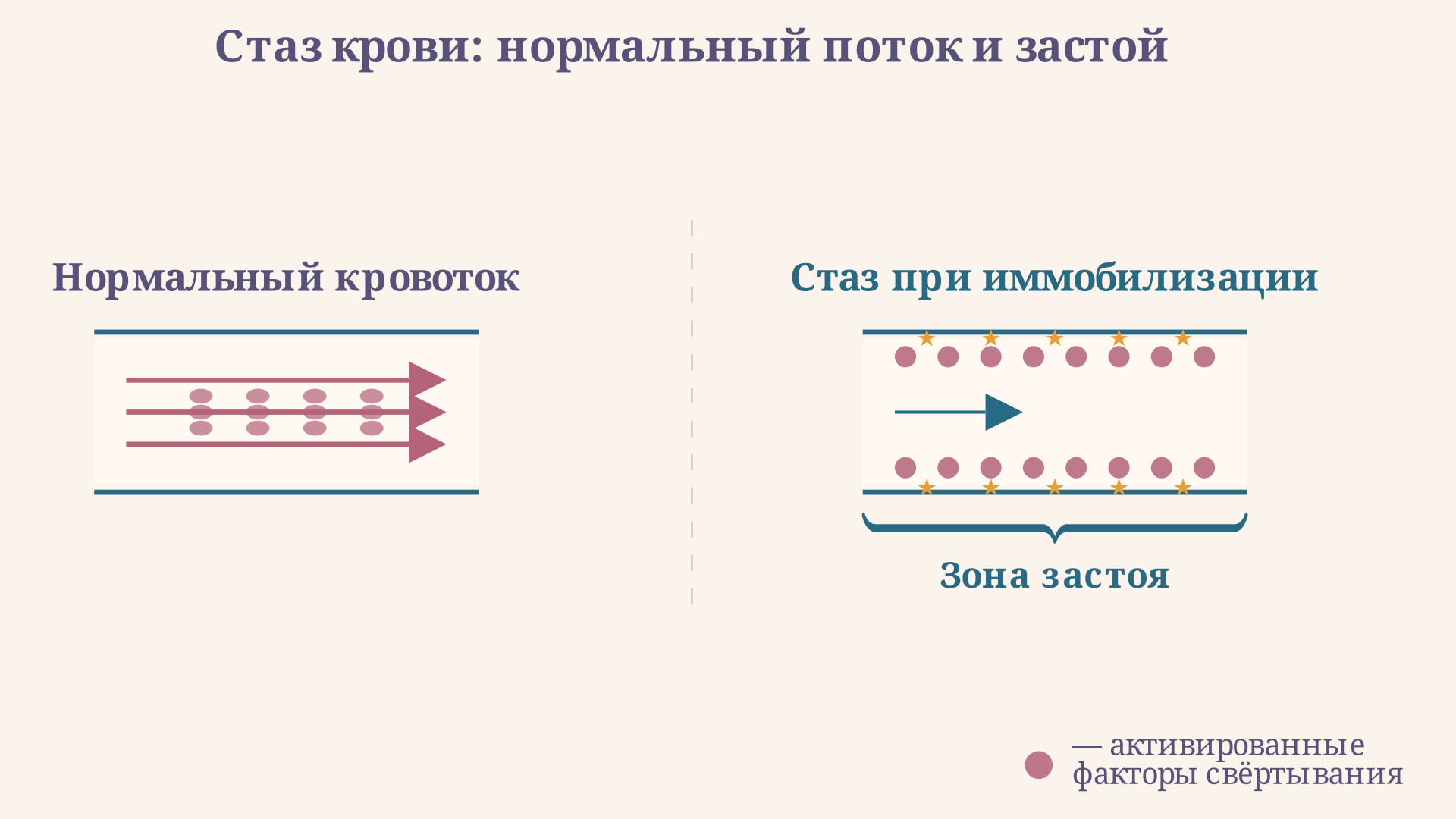 Схема стаза в глубоких венах голени: при иммобилизации кровоток замедляется, активированные факторы свёртывания накапливаются у стенки венозных синусов