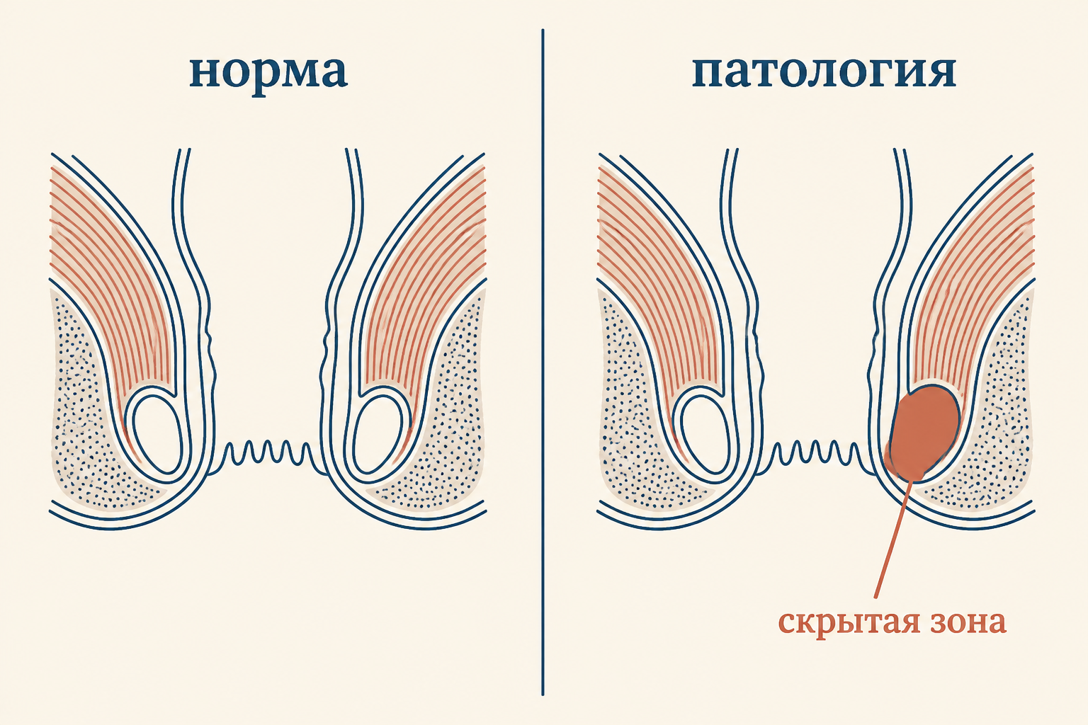Сравнение: слева симметричные пустые карманы (норма), справа один карман заполнен опухолью - скрытая зона роста