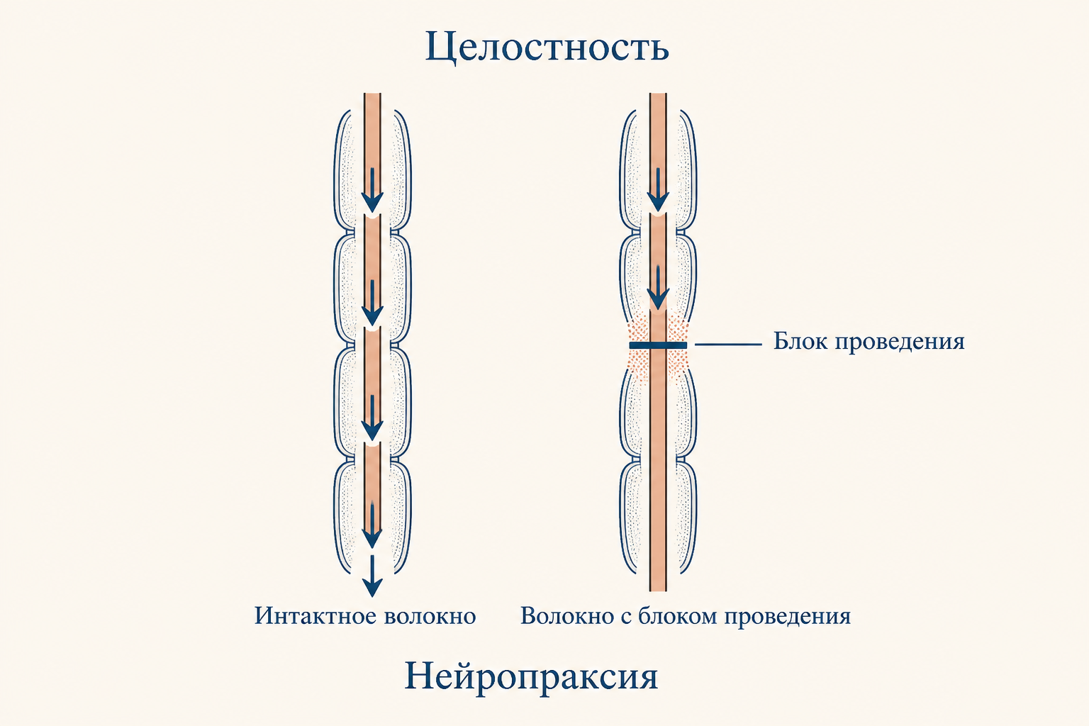 Схема анатомической целостности нервного волокна: интактный аксон и участок с блоком проведения